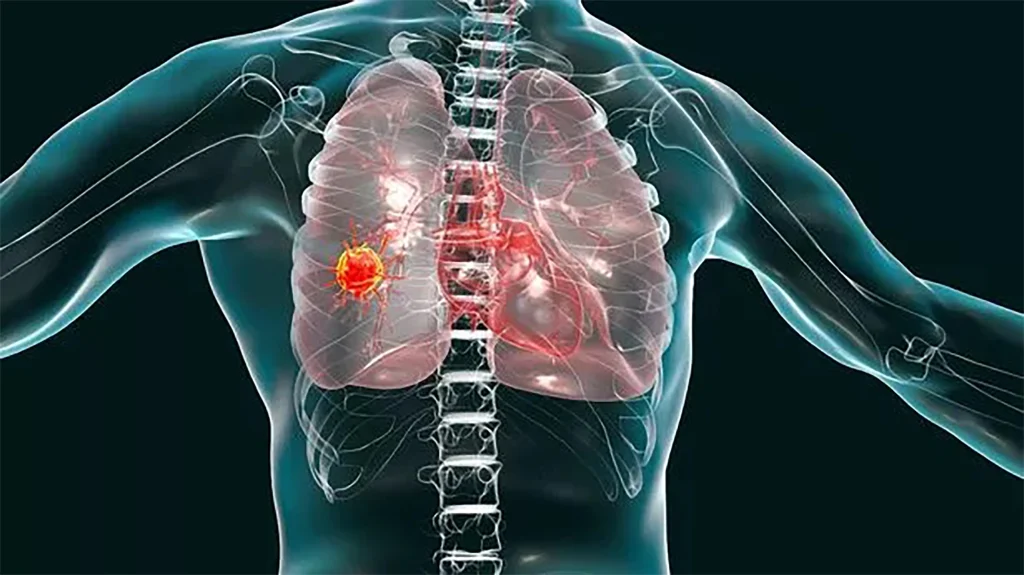How can I detect cancer early?